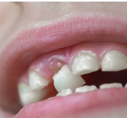 Inilah Beberapa Arti Mimpi Gigi Copot Beserta Faktor yang Mempengaruhinya